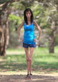 Lizzie Velasquez feet photo 6
