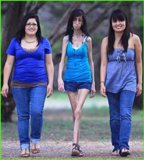 Lizzie Velasquez feet photo 5