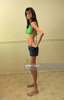 Lizzie Velasquez feet photo 2